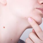 Skin Tag Removal